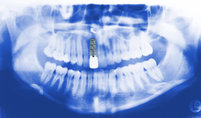 Röntgenbild Einzelzahn Implantat in der Front